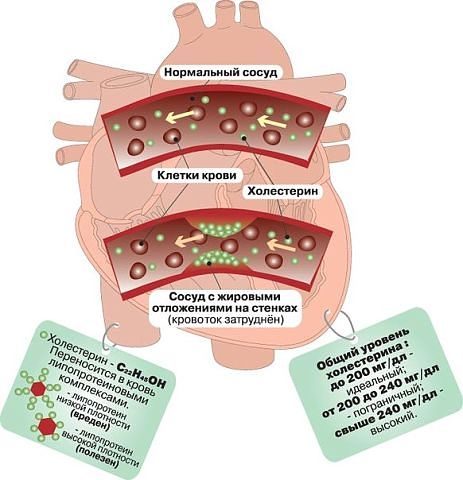 Очищаем сосуды от холестерина в домашних условиях
